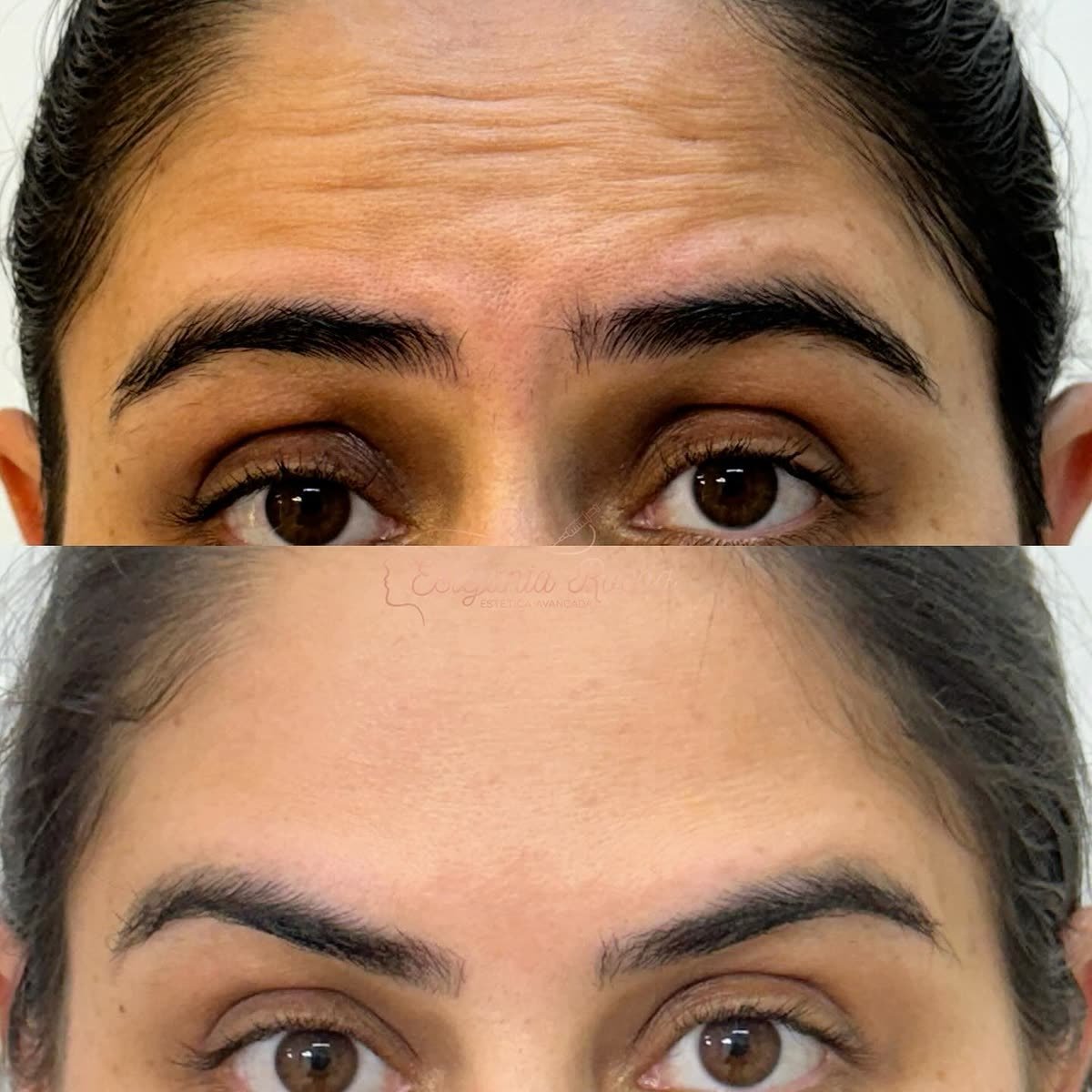Antes e depois: suavização das linhas da testa, Dra. Estefania Rocha em Conceição do Rio Verde