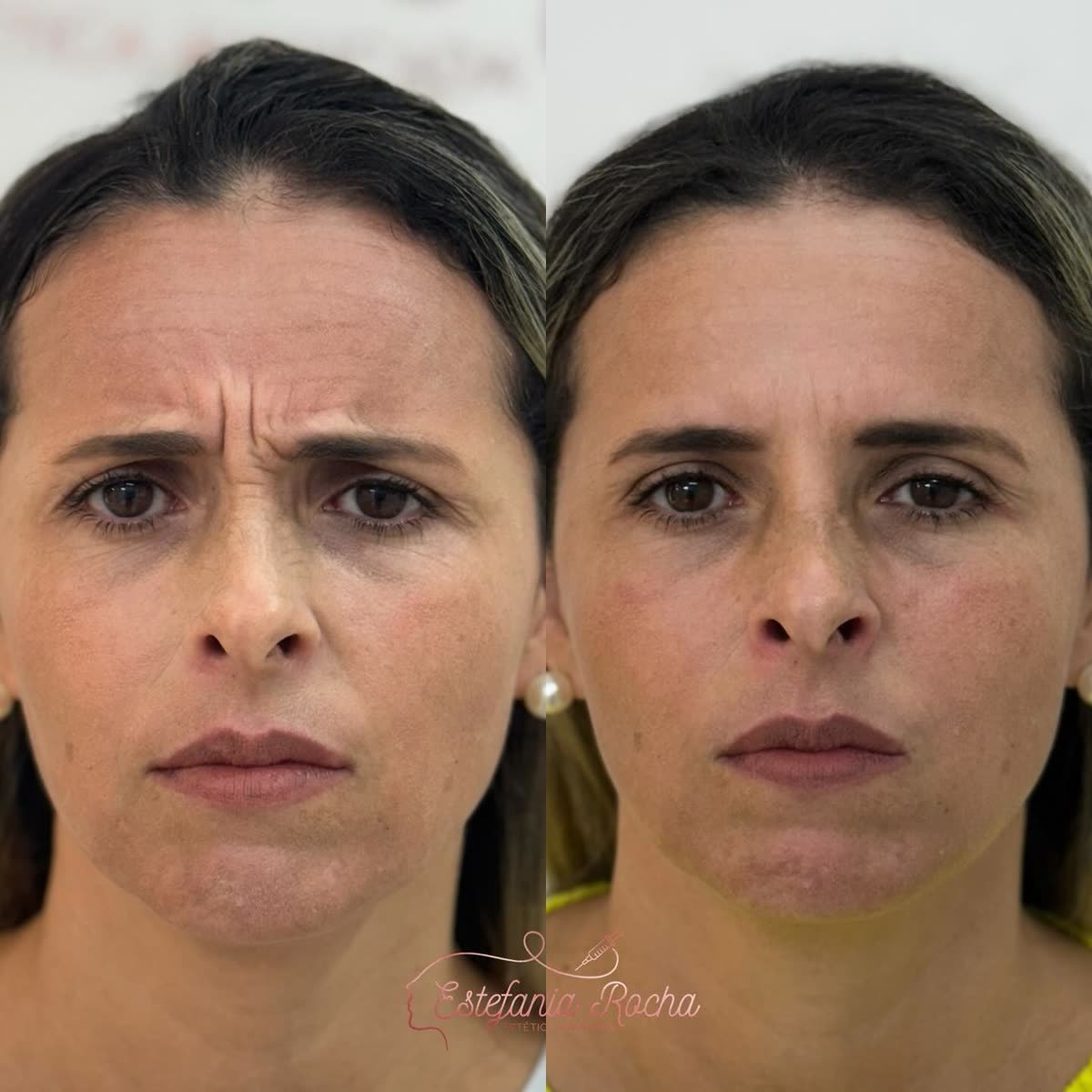 Antes e depois: suavização das linhas entre as sobrancelhas, Dra. Estefania Rocha em Conceição do Rio Verde