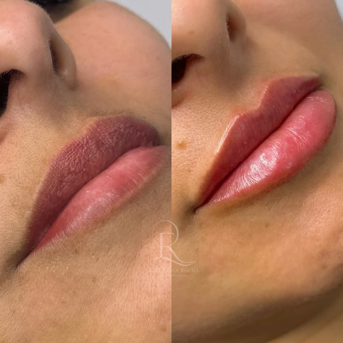 Antes e depois: lábios com contorno e volume naturais, Dra. Estefania Rocha em Conceição do Rio Verde