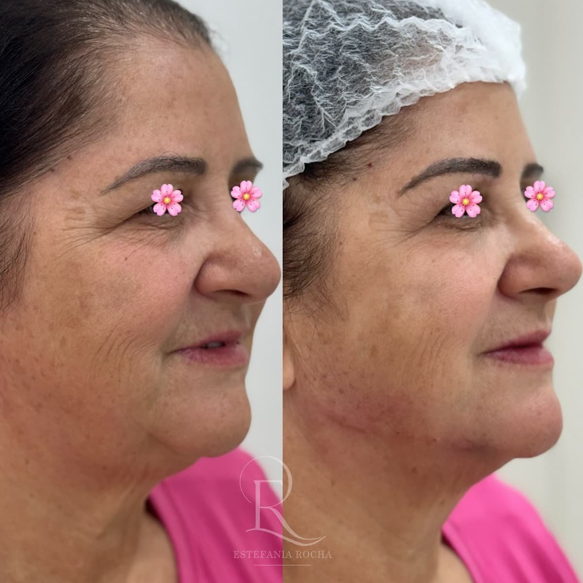 Antes e depois: contorno facial e perfil, Dra. Estefania Rocha em Conceição do Rio Verde