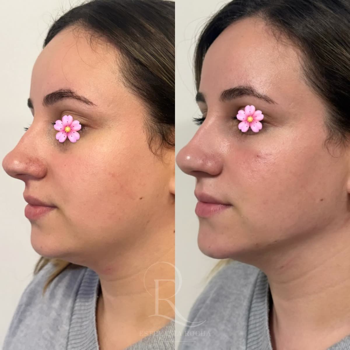 Antes e depois: definição do perfil e do contorno, Dra. Estefania Rocha em Conceição do Rio Verde