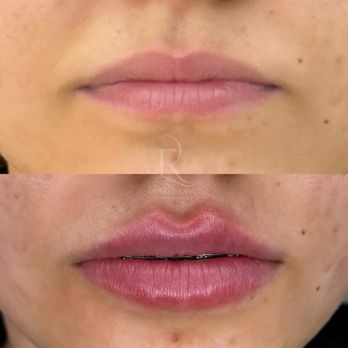 Antes e depois: lábios realçados, Dra. Estefania Rocha em Conceição do Rio Verde