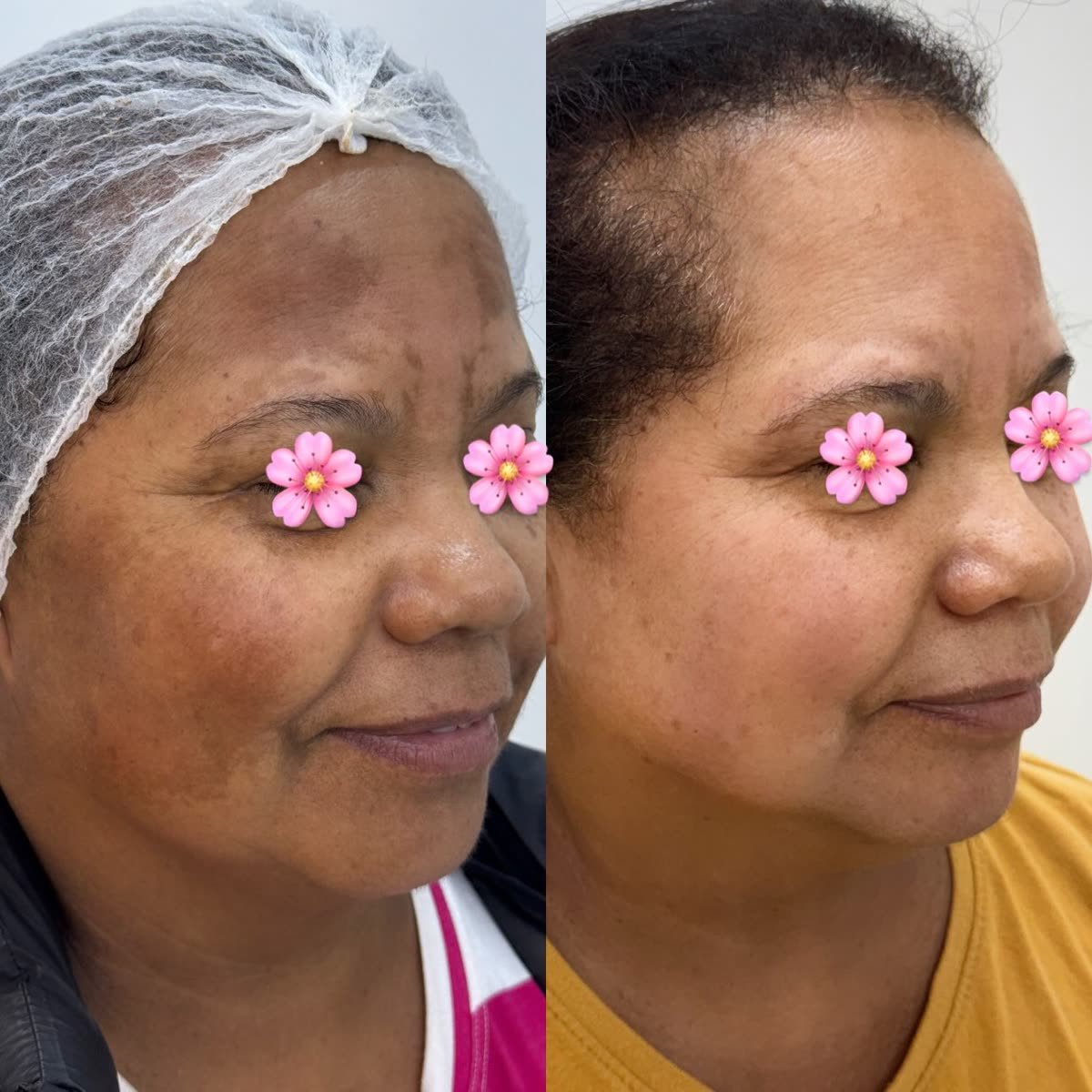 Antes e depois: linhas de expressão da testa, Dra. Estefania Rocha em Conceição do Rio Verde